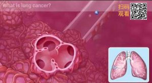 5分钟读懂非小细胞肺癌带二维码.jpg
